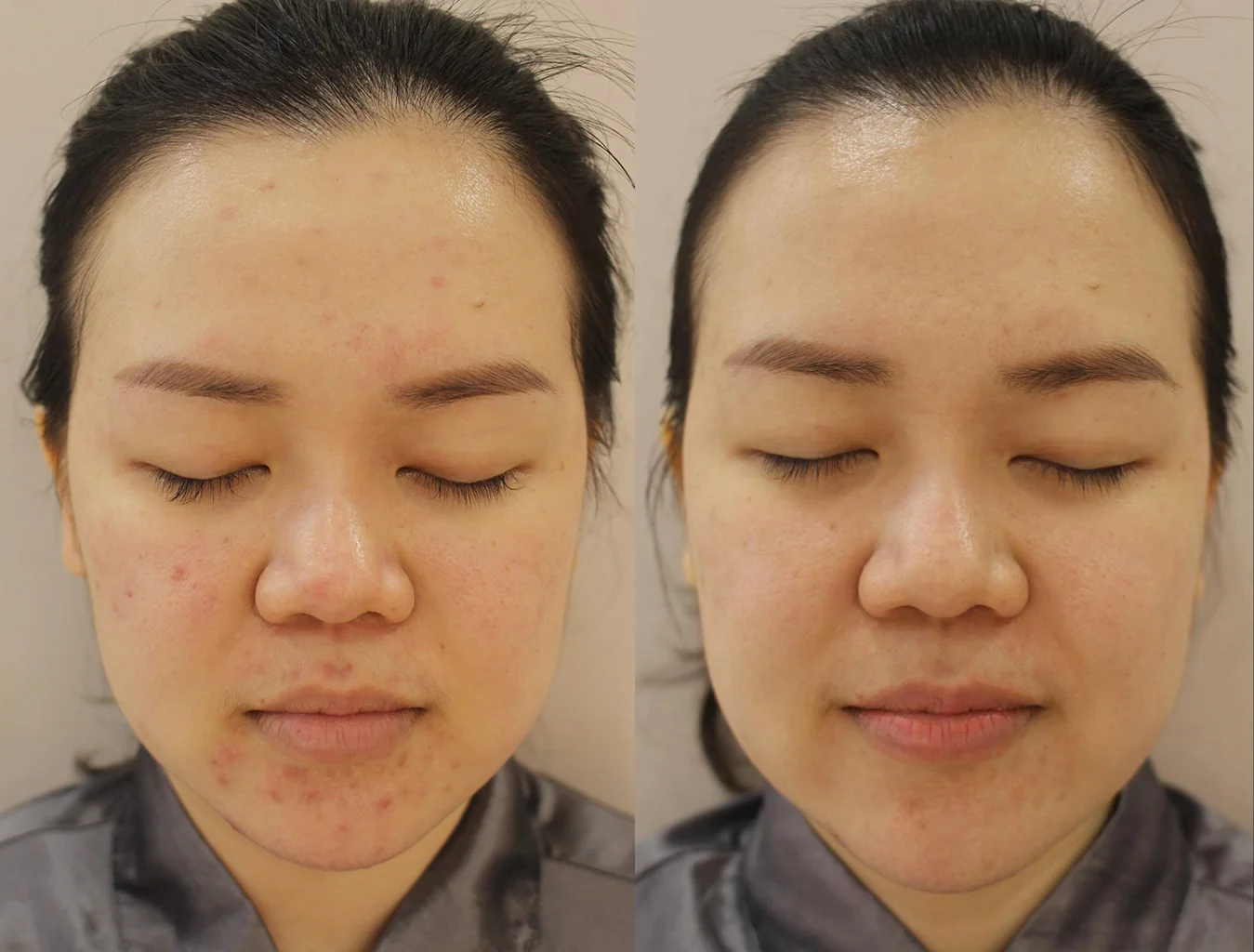 Anti Blemish Luxurious Care: before and after