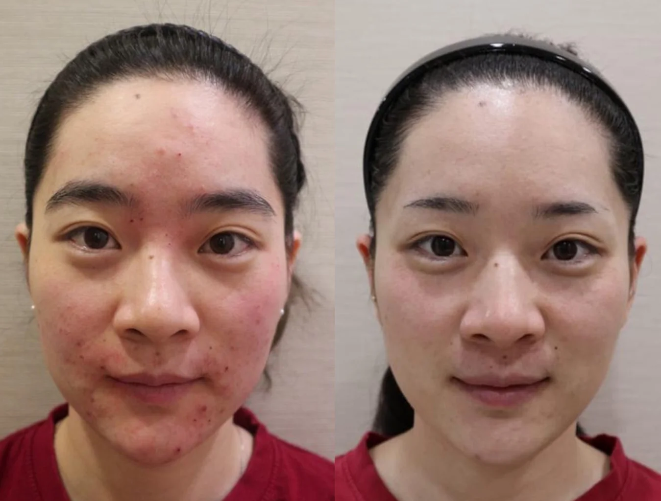 Anti Blemish Luxurious Care: before and after