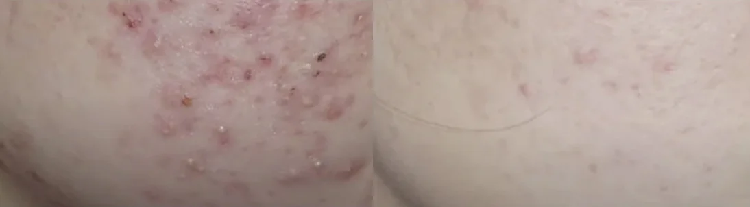 Carbon Clear Care Treatment: before and after