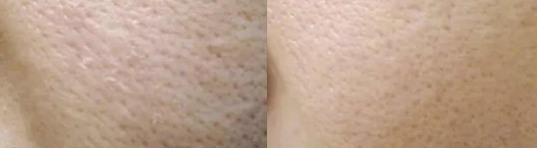 Carbon Clear Care Treatment: before and after