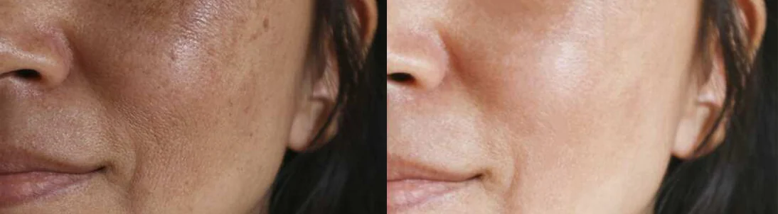 Hydra HA Plus Care: before and after