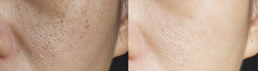 Hydra HA Plus Care: before and after