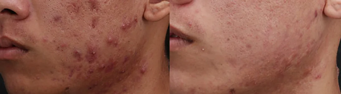 Oil Control Care for Men: before and after