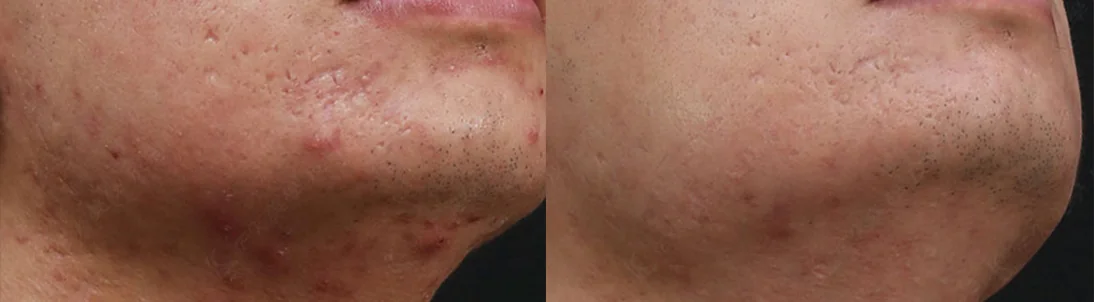 Oil Control Care for Men: before and after