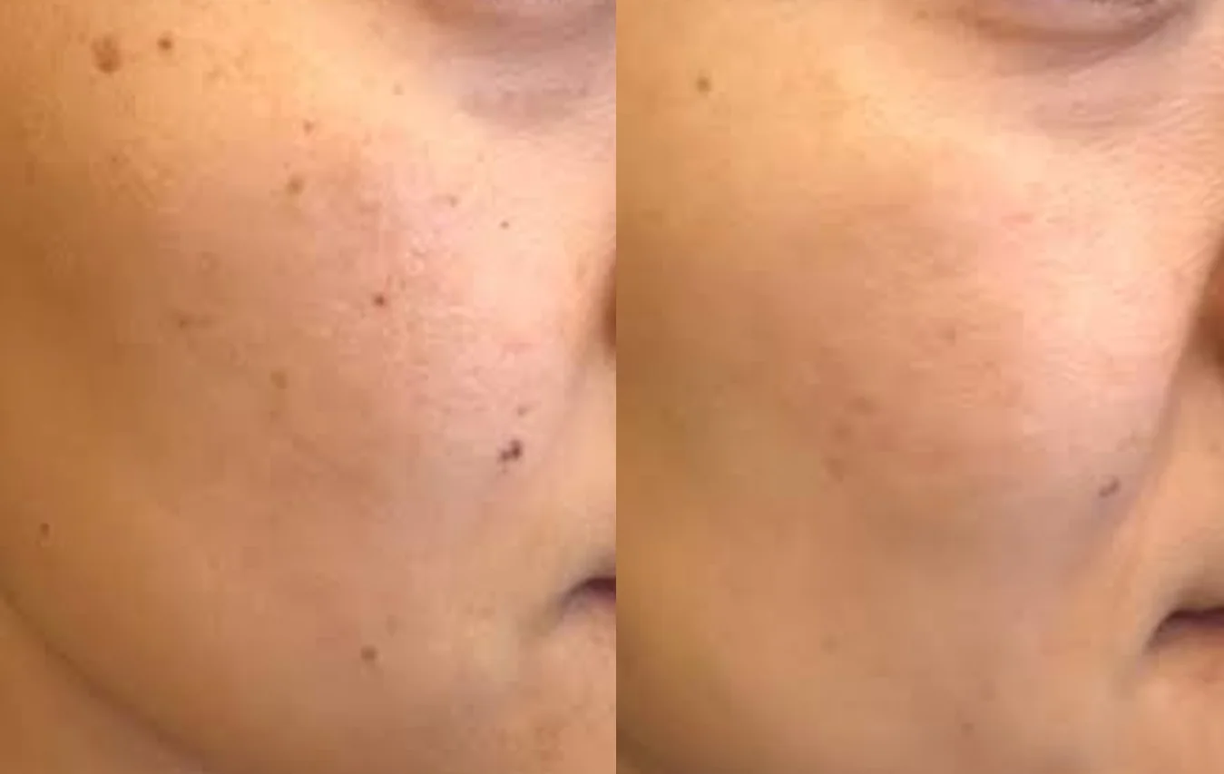 Discolouration Luxurious Care: before and after