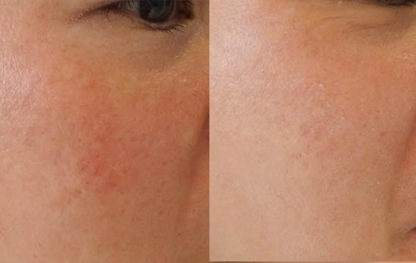 Discolouration Luxurious Care: before and after