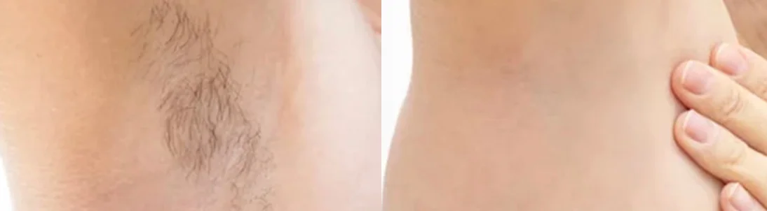 Super Hair Removal (SHR): before and after