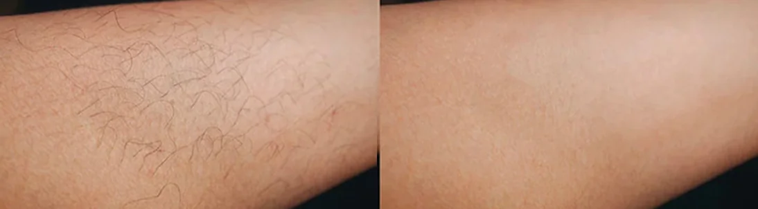 Super Hair Removal (SHR): before and after