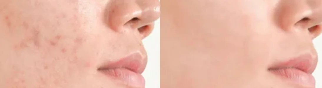 Super Skin Rejuvenation (SSR): before and after