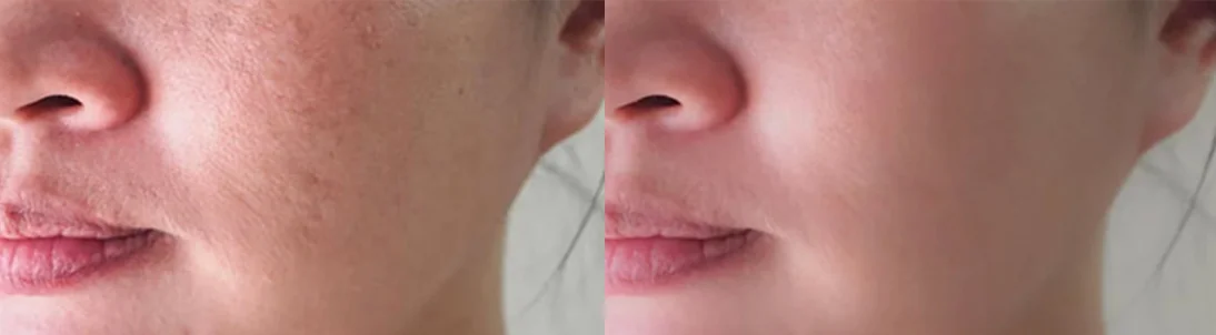 Super Skin Rejuvenation (SSR): before and after