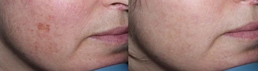 Super Skin Rejuvenation (SSR): before and after