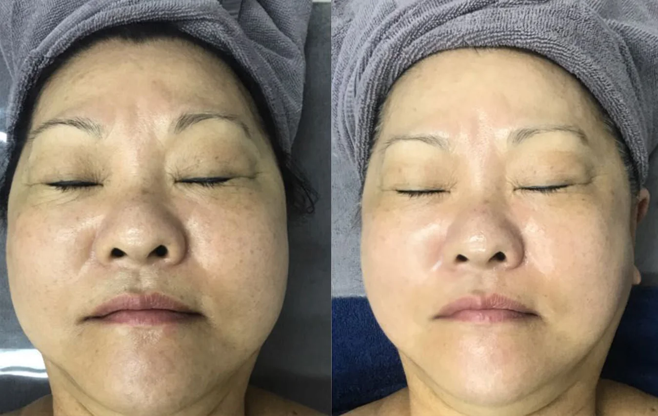 Tri-Lift Care: before and after