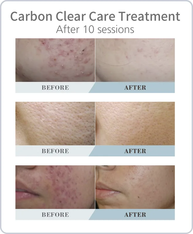 Three before-and-after close-ups of acne-prone skin after 10 Carbon Clear Care sessions