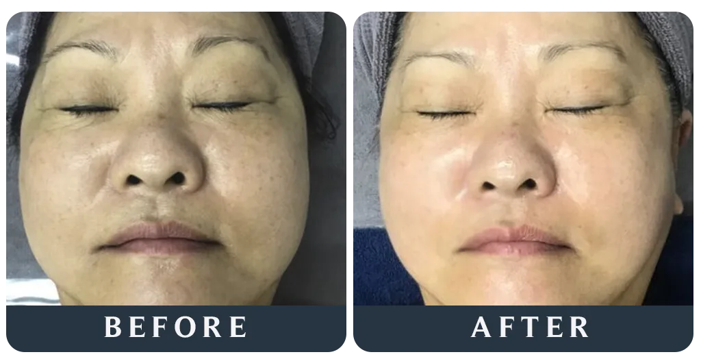 Before and after: a client's dull, uneven complexion looking brighter and more even