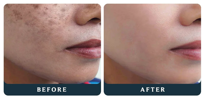 Before and after: pigmentation and dark spots on a client's cheek visibly lighter