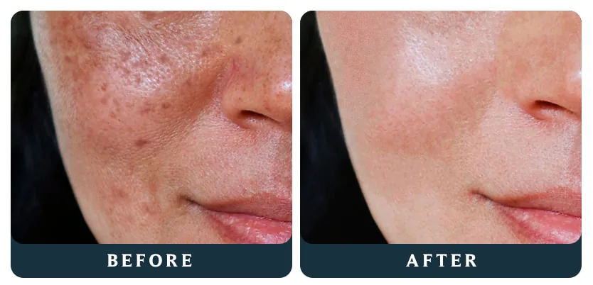 Discolouration Luxurious Care: before and after