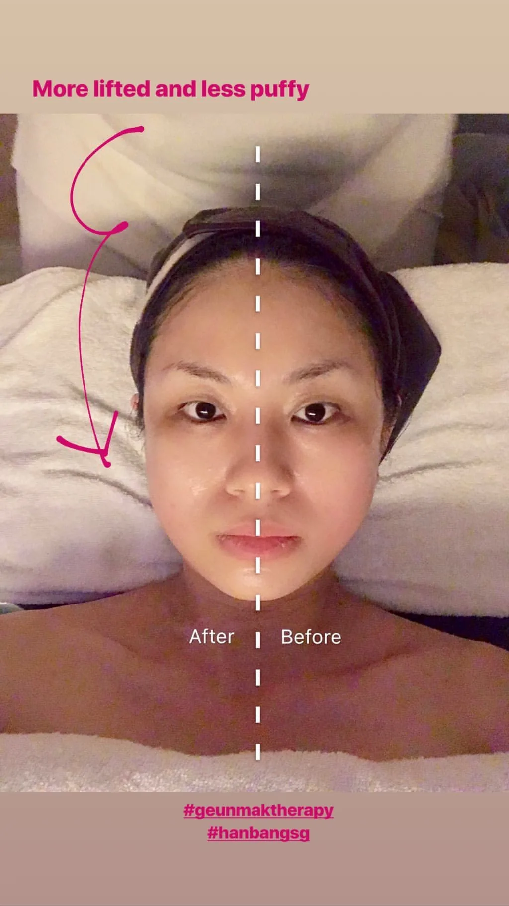 Instagram story: a split before-and-after selfie, captioned 'More lifted and less puffy'