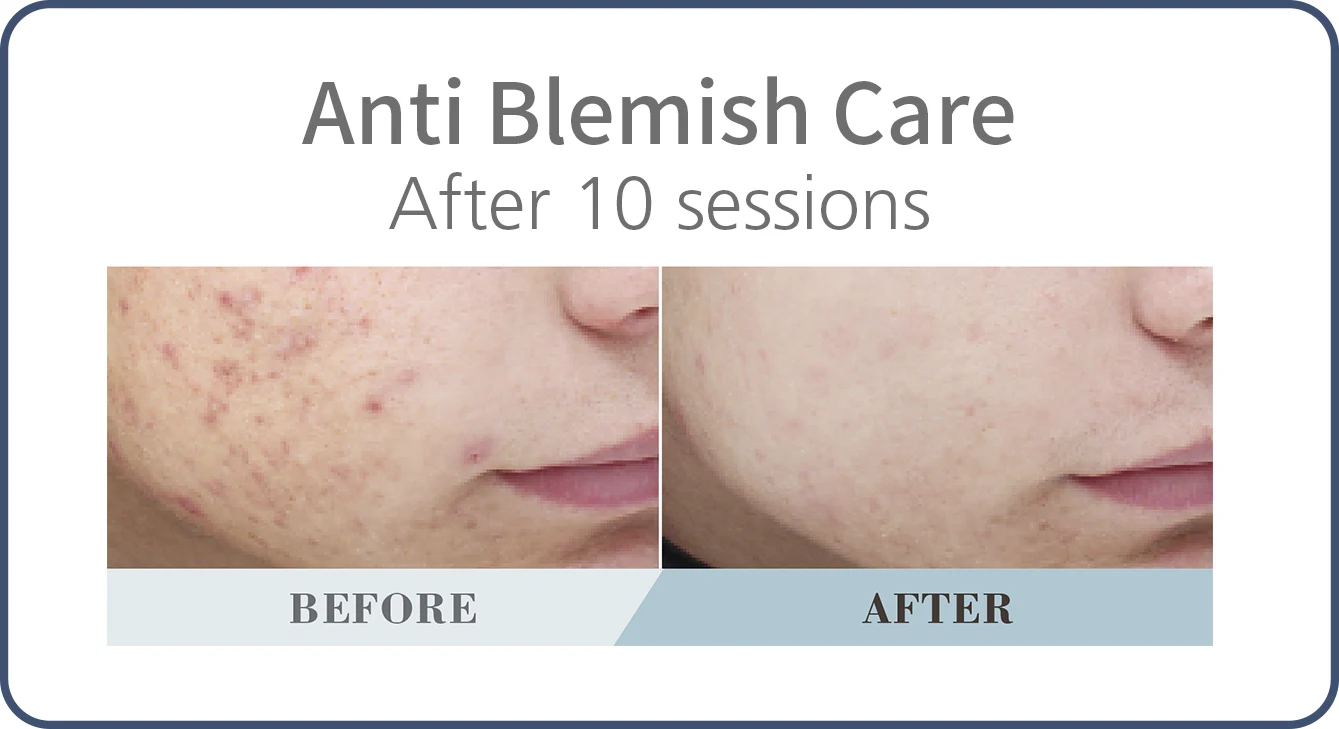 Anti Blemish Luxurious Care: before and after