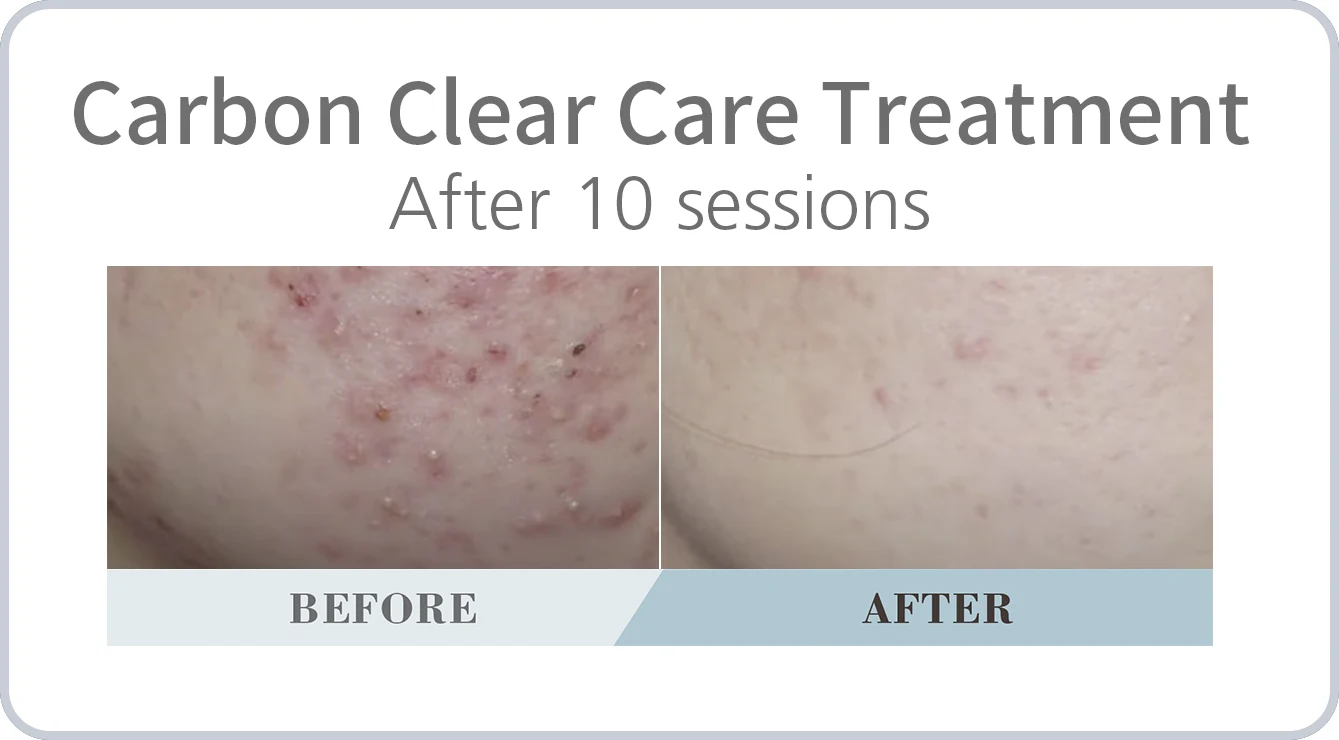 Carbon Clear Care Treatment: before and after