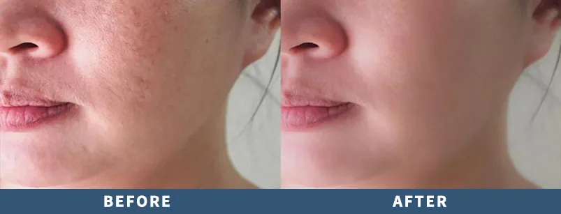 Collagen skin repair: before and after