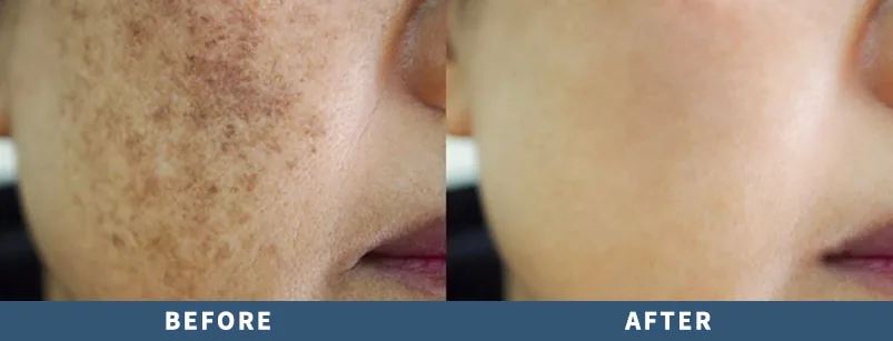 Pigmentation skin repair: before and after