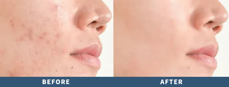 Acne skin repair: before and after